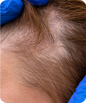 woman-getting-hair-loss-treatment-clinic